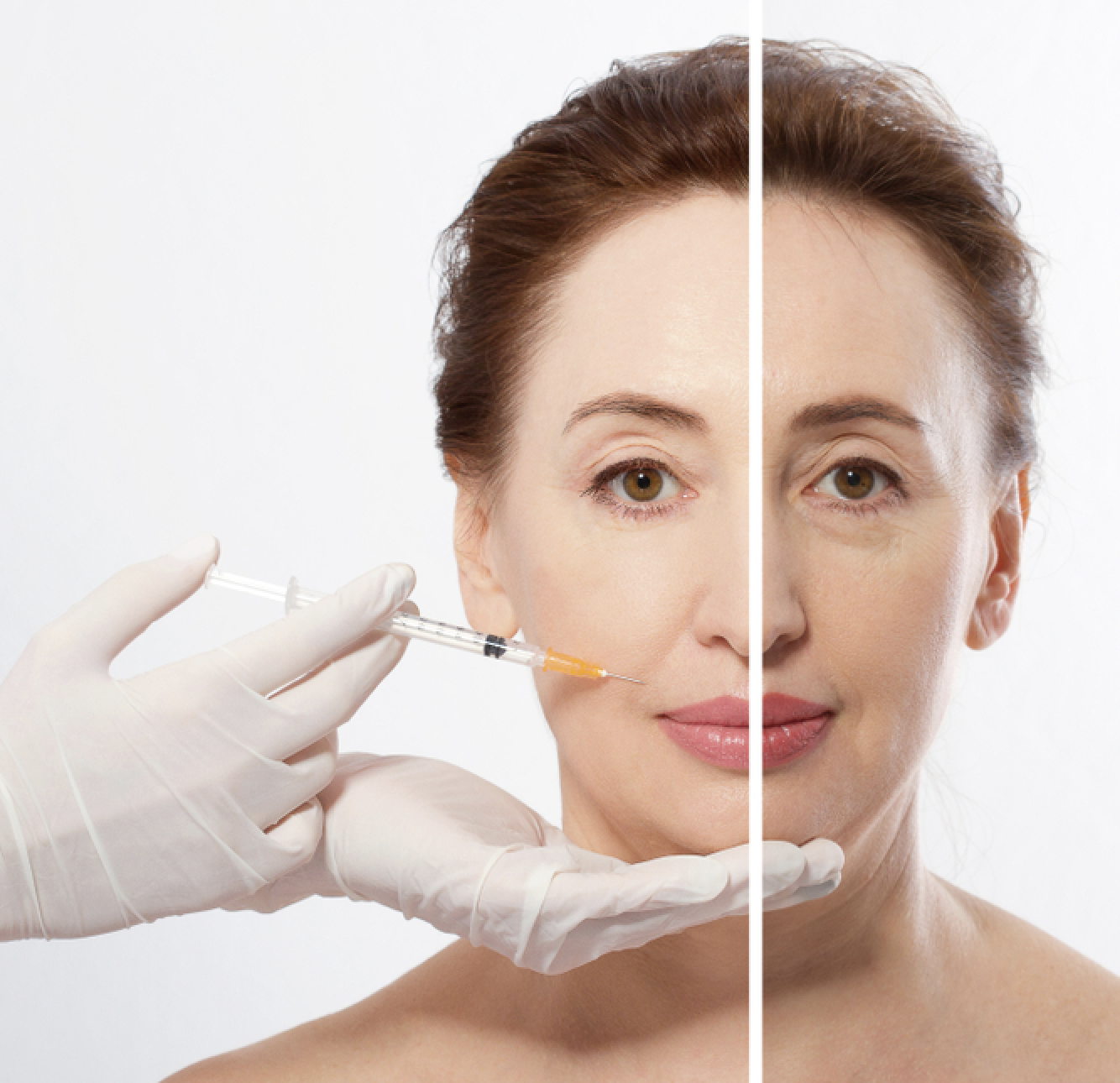 how-long-do-dermal-fillers-last